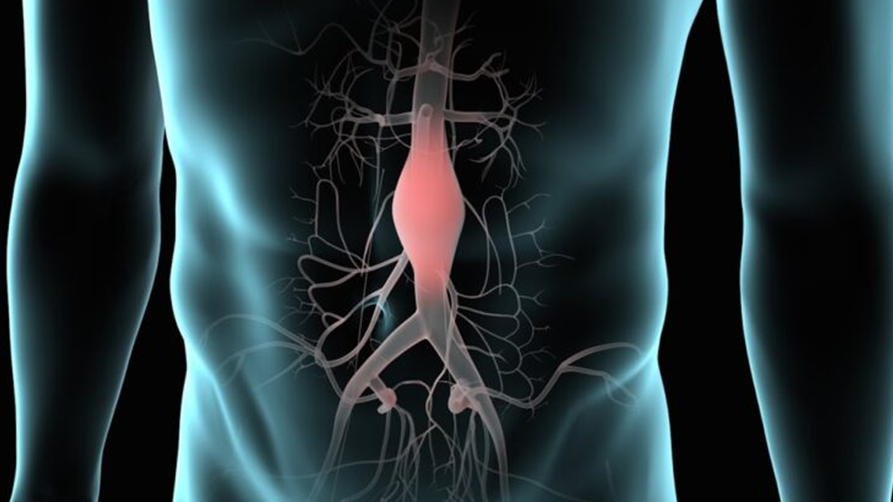 ¿Qué es un aneurisma estomacal? 