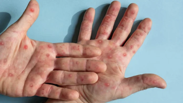 Viruela del mono llegó a Colombia: qué es, cómo se contagia, síntomas y cómo cuidarse Viruela del mono llegó a Colombia: qué es, cómo se contagia, síntomas y cómo cuidarse