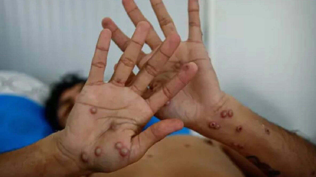 ¿Cómo se contagia la viruela del mono?